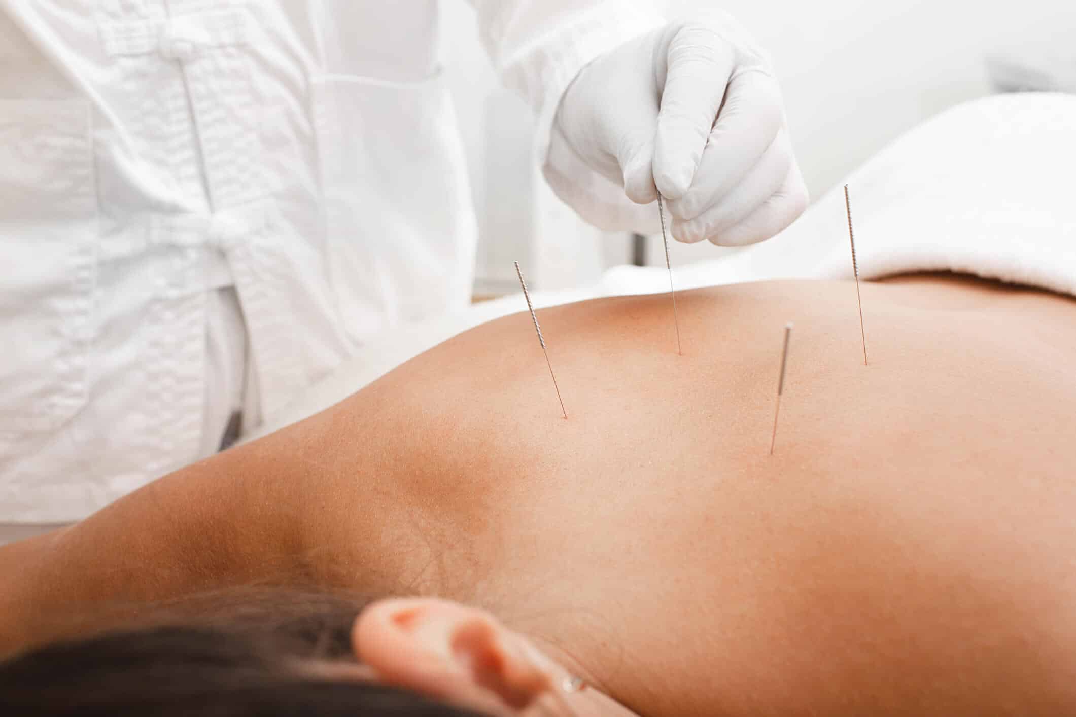 Akupunktur-Massage nach Radloff