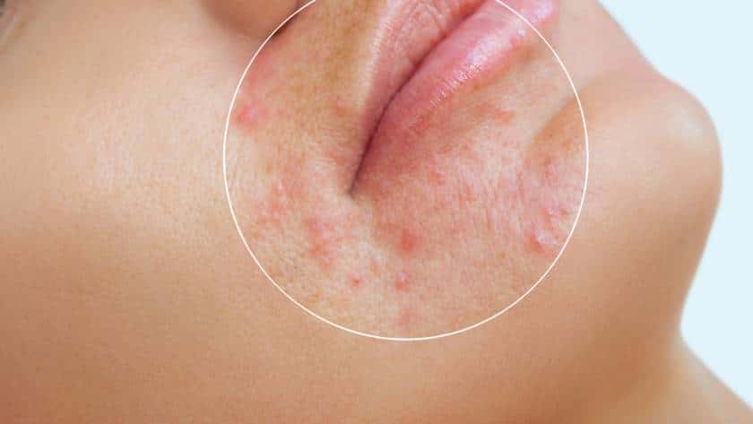 exc.beauty-medizin-akneentfernung